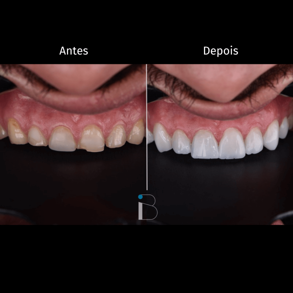 Antes e depois - Instituto Baumeier (1)