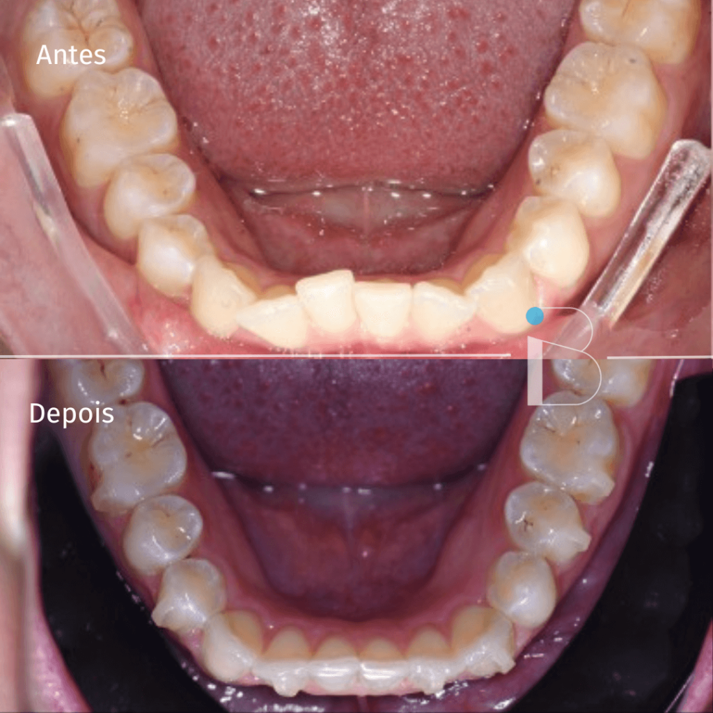 Antes e depois - Instituto Baumeier (10)