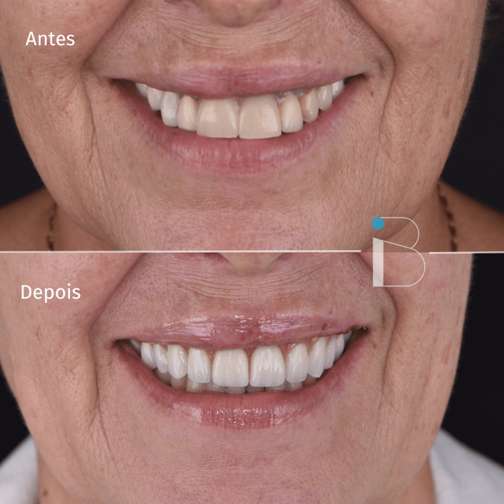 Antes e depois - Instituto Baumeier (4)