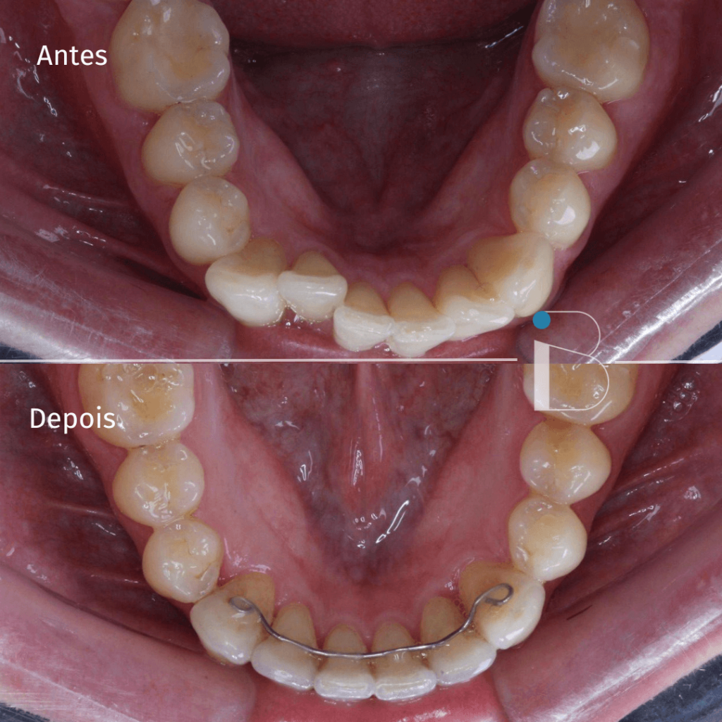 Antes e depois - Instituto Baumeier (5)