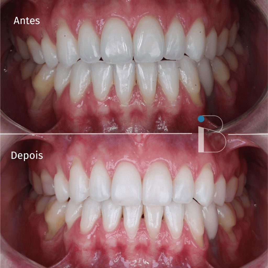 Antes e depois - Instituto Baumeier (7)