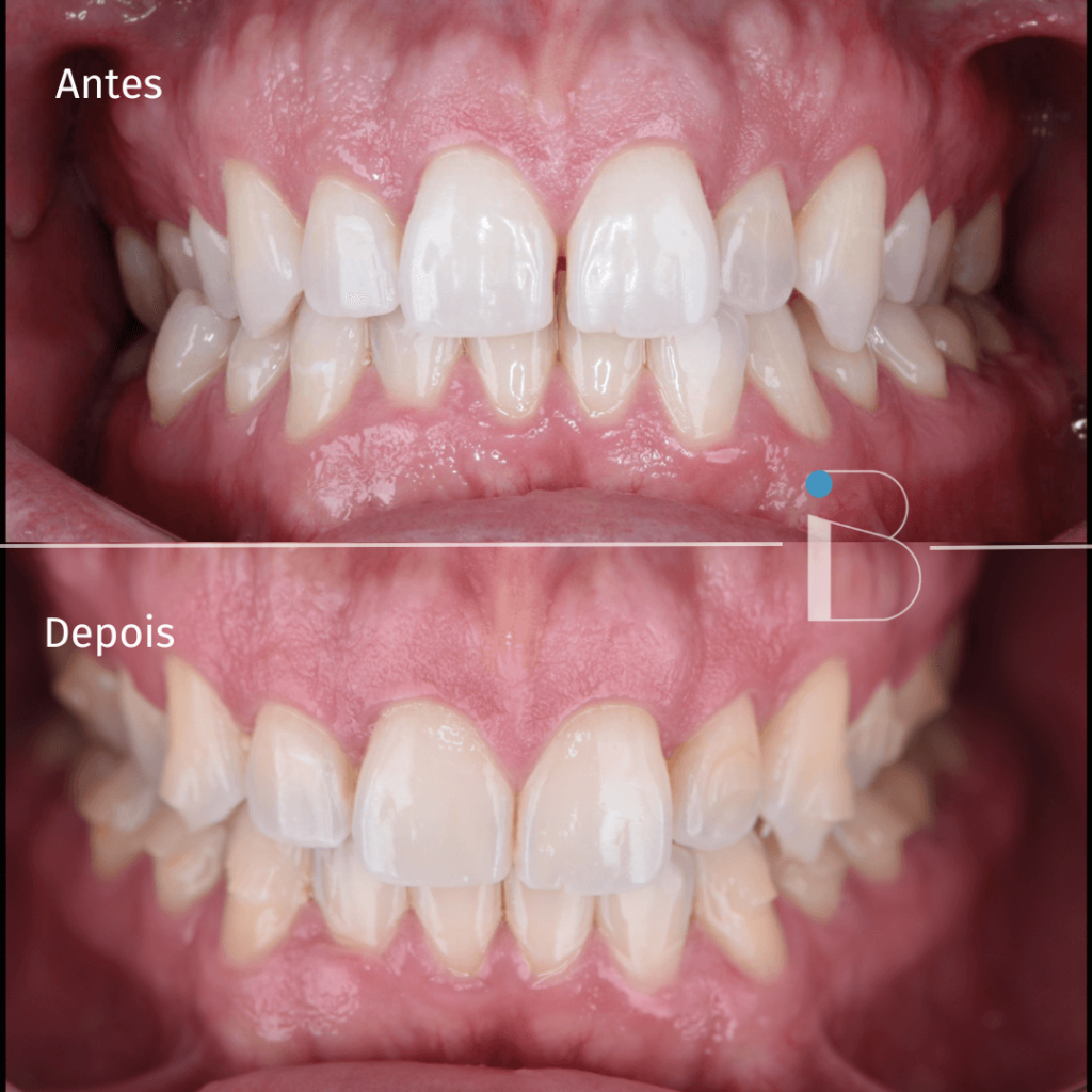Antes e depois - Instituto Baumeier (8)