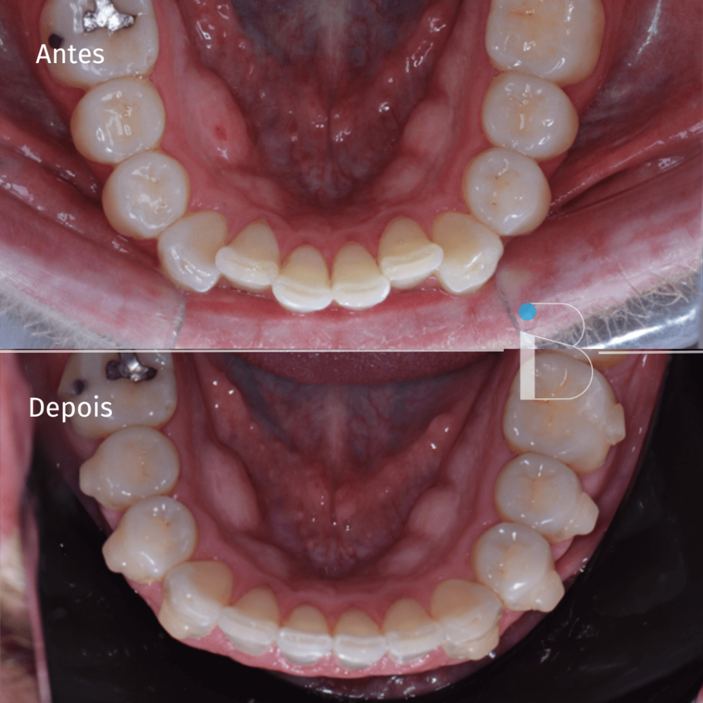 Antes e depois - Instituto Baumeier (9)